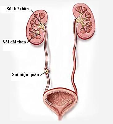 Phẫu thuật nội soi sau phúc mạc lấy sỏi niệu quản