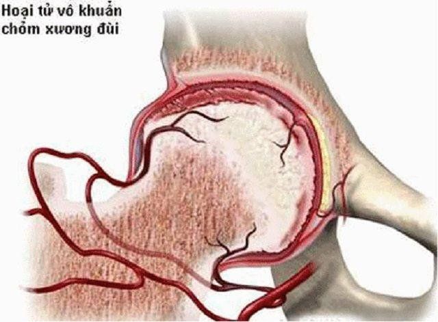 Chụp cộng hưởng từ (MRI) khớp háng