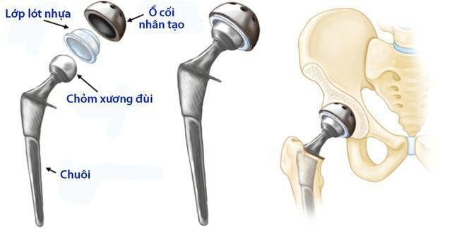 Lưu ý trong điều trị và chăm sóc người cao tuổi bị gãy cổ xương đùi