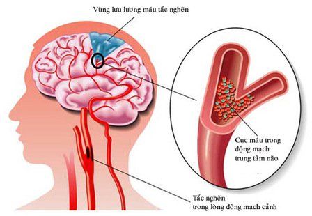 Tìm hiểu về kỹ thuật ECMO (Tim - phổi nhân tạo)