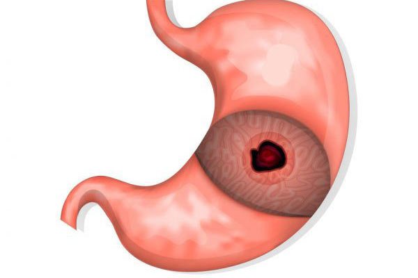 Rửa dạ dày: Chỉ định và chống chỉ định