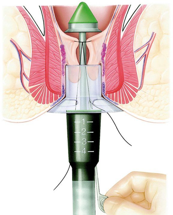 Những điều cần biết về bệnh trĩ