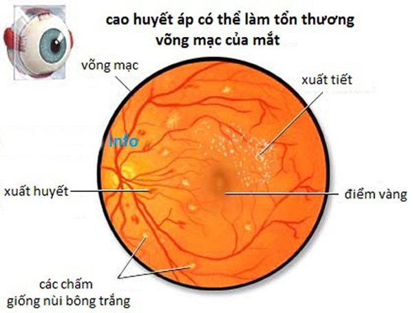 Sự khác biệt giữa bệnh võng mạc tiểu đường và bệnh võng mạc tăng huyết áp