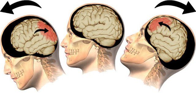 Những điều cần biết về cấp cứu chấn thương sọ não