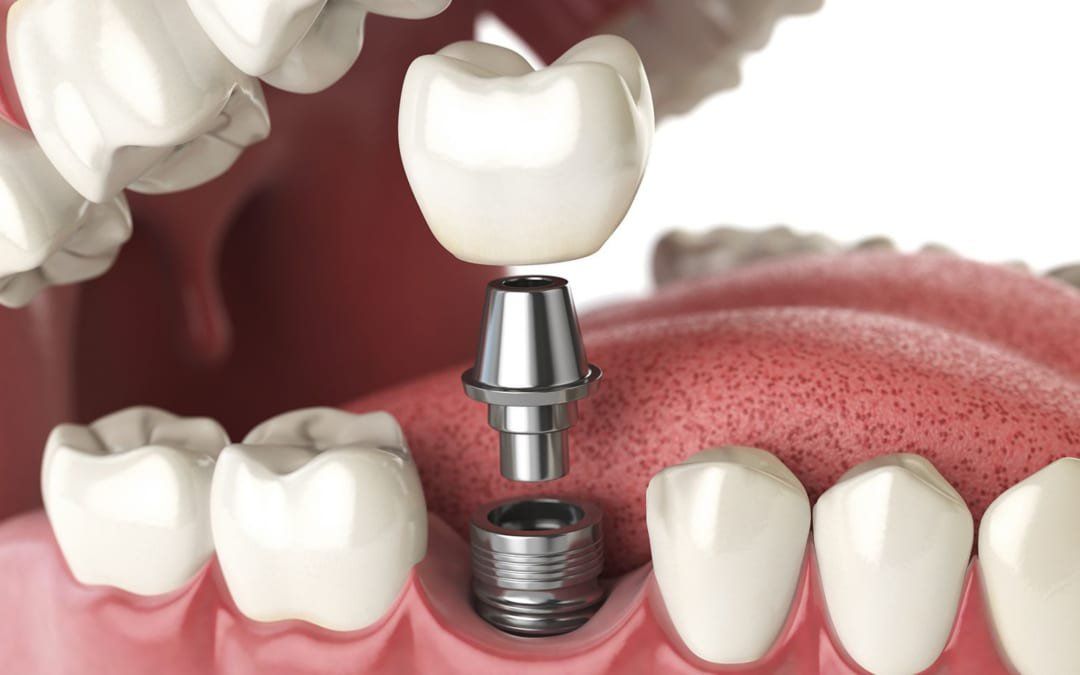 Trồng răng giả bị lung lay: Nguyên nhân và cách khắc phục