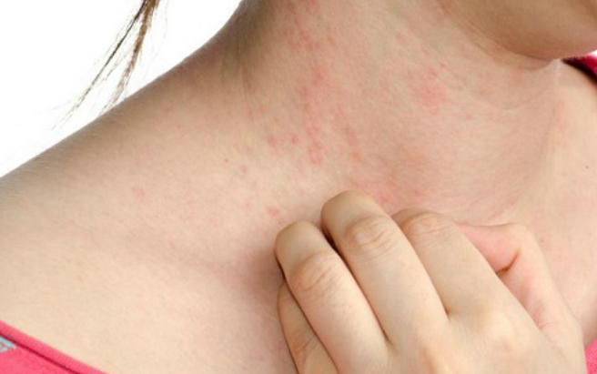 Bệnh bóng nước dạng PEMPHIGUS: Dấu hiệu, nguyên nhân và cách điều trị