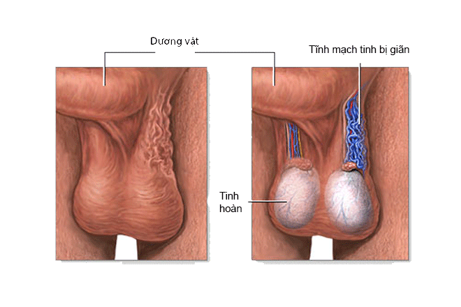Siêu âm trong giãn tĩnh mạch thừng tinh