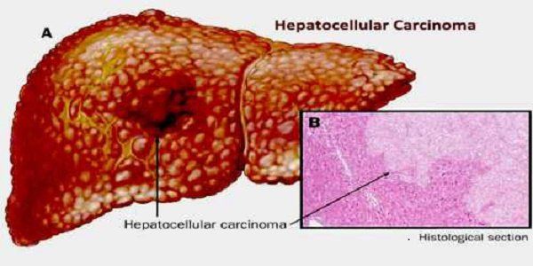 Thuốc Atezolizumab: Công dụng, chỉ định và lưu ý khi dùng