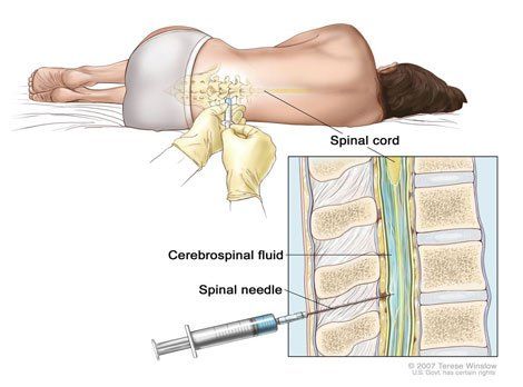 Dấu hiệu đau dây thần kinh ngoại biên