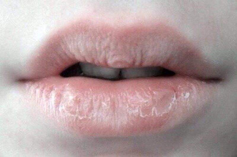Isotretinoin là thuốc gì? Công dụng và chỉ định