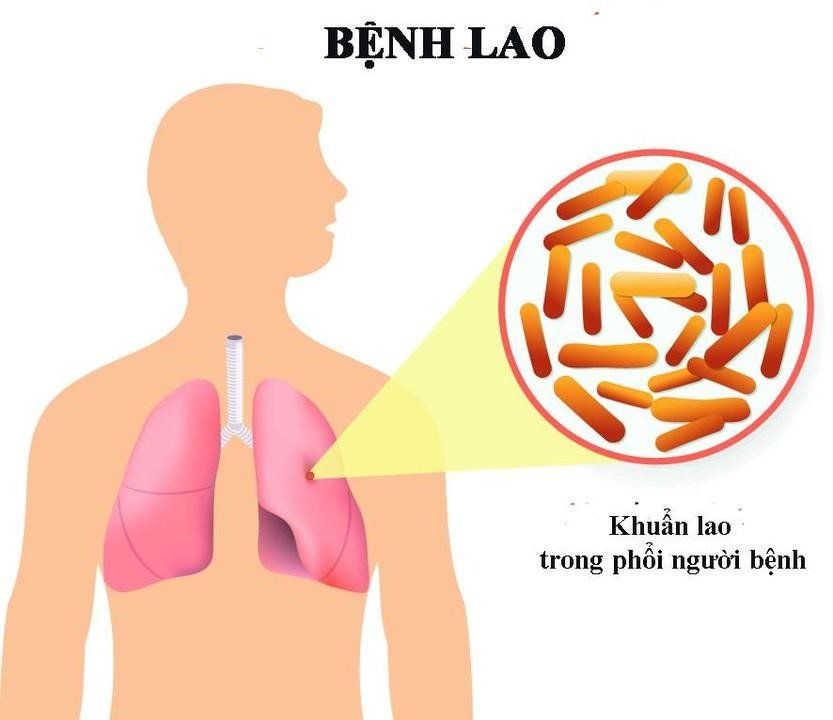 Triệu chứng của bệnh AIDS
