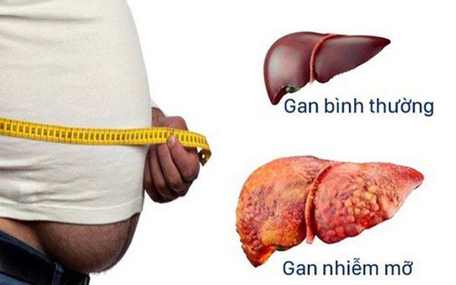 Hiệu quả và an toàn của thuốc chống xơ gan không virus