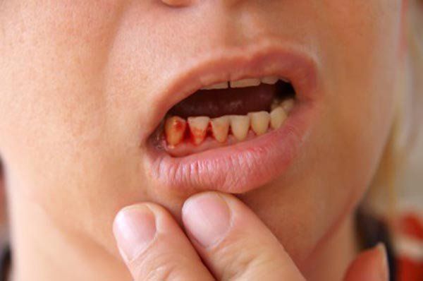 Các dấu hiệu của bệnh gan liên quan đến rượu