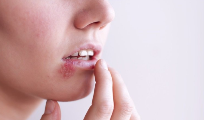 Thuốc chống kháng virus Acyclovir: Công dụng, liều dùng, tác dụng phụ