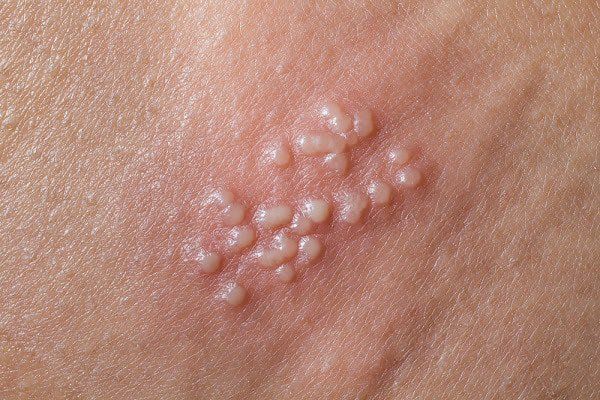 Vắc-xin Gardasil