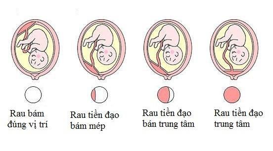 Các trường hợp sản phụ bắt buộc sinh mổ