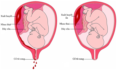 Các trường hợp sản phụ bắt buộc sinh mổ
