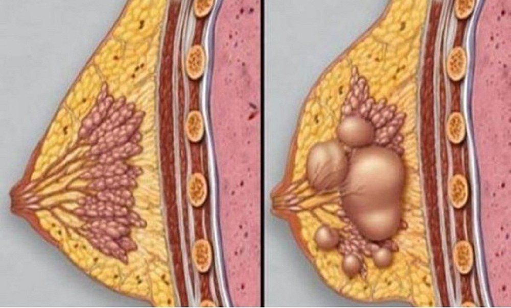 Sự khác nhau giữa cương sữa và tắc tia sữa