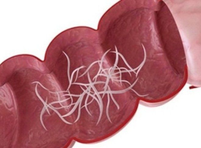 Đau bụng giun khác gì đau bụng thông thường?