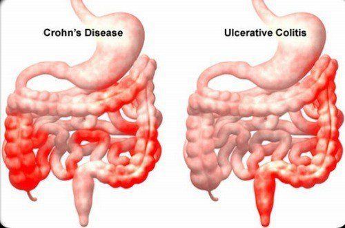 Thuốc chống tiêu chảy cho bệnh Crohn