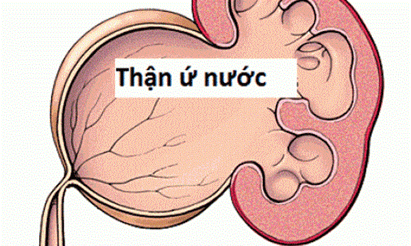 Hình ảnh siêu âm thận móng ngựa