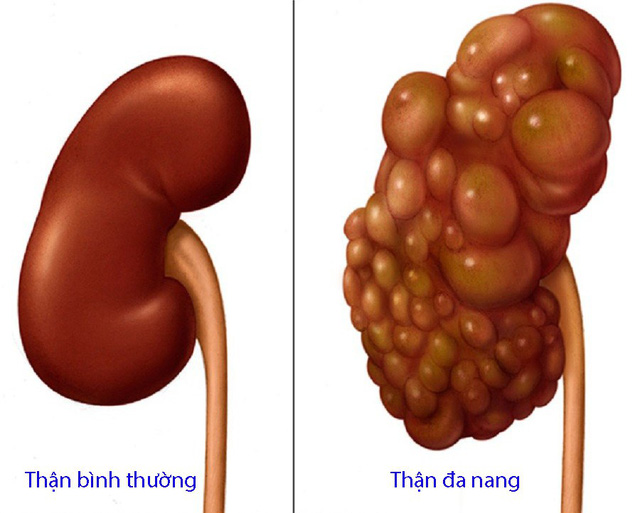 Biến chứng của thận đa nang