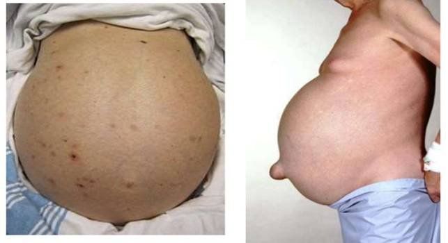 Nguyên nhân, triệu chứng tràn dịch màng bụng