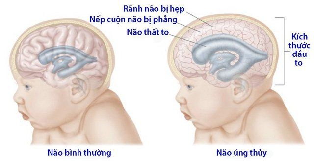 Siêu âm sàng lọc bất thường thai ở tam cá nguyệt thứ nhất trong thai kỳ