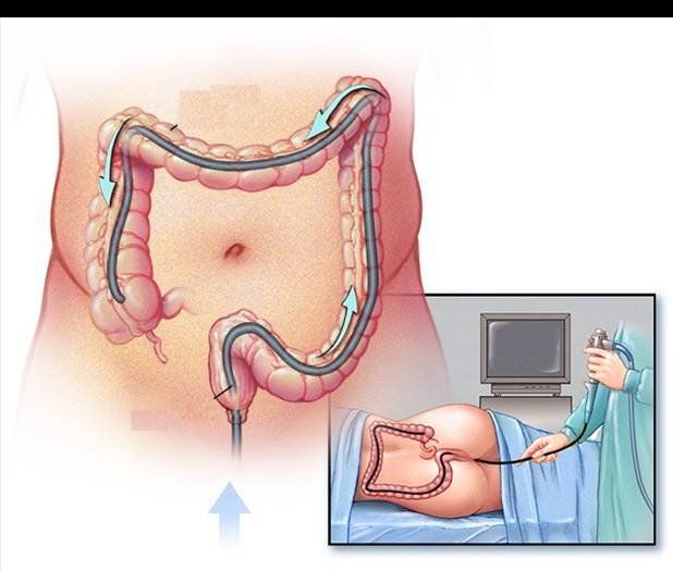 Trước khi nội soi trực tràng: Có cần nhịn ăn?