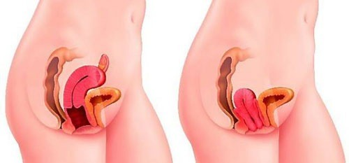 Sa tử cung dễ gặp khi sinh thường hay sinh mổ?