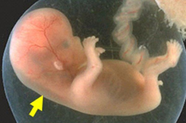 Siêu âm sàng lọc bất thường thai ở tam cá nguyệt thứ nhất trong thai kỳ