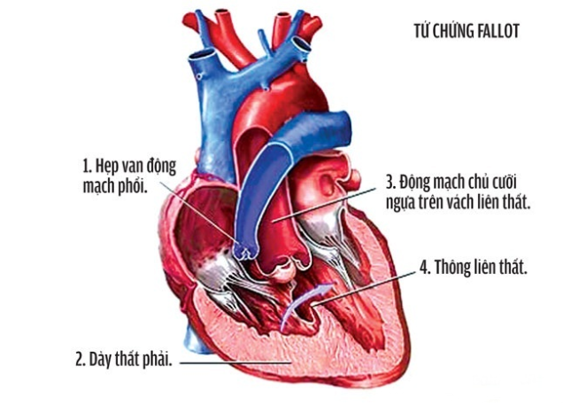 Các loại dị tật tim bẩm sinh thường gặp