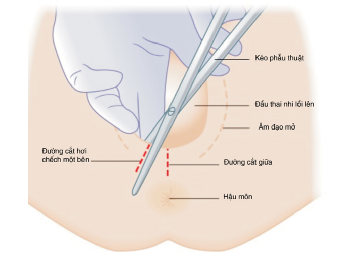 Vết khâu sau sinh bị hở có đáng ngại?