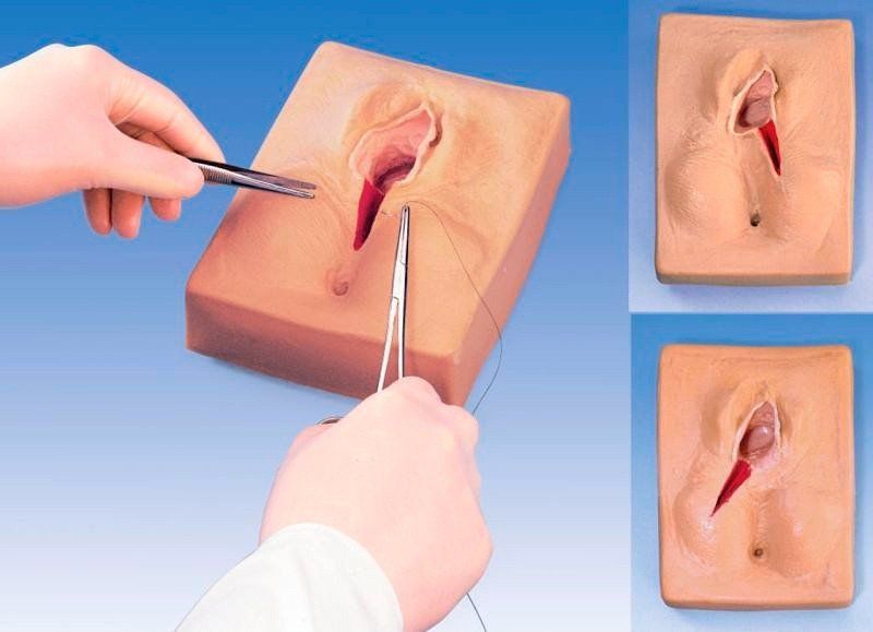 Vết khâu sau sinh bị hở có đáng ngại?