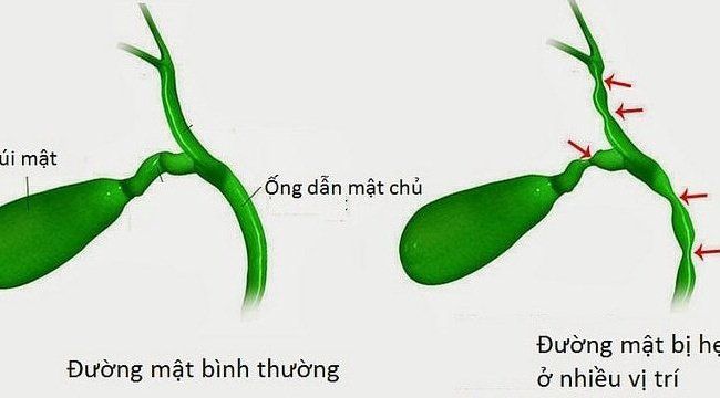 Nguyên nhân và triệu chứng của teo đường mật