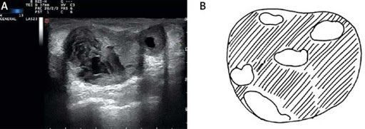 U nang tuyến vú đơn thuần: Những điều cần biết