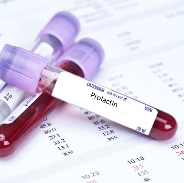 Khi nào cần xét nghiệm hormone prolactin?