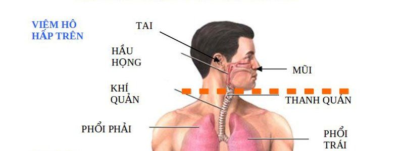 Gây mê mask thanh quản phẫu thuật nội soi hỗ trợ kẹp túi phình