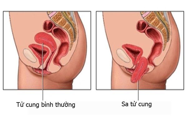 Khả năng mang thai và sinh con khi bị sa tử cung