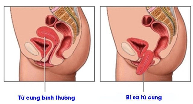 Phẫu thuật sa sinh dục có nguy hiểm không?