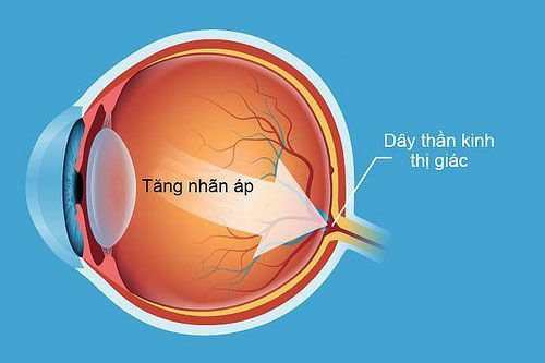 Soi góc tiền phòng đánh giá tình trạng góc tiền phòng