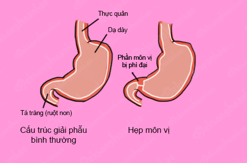 Chẩn đoán và điều trị hẹp môn vị