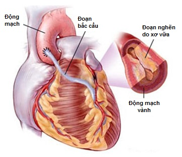 Các phương pháp điều trị nhồi máu cơ tim