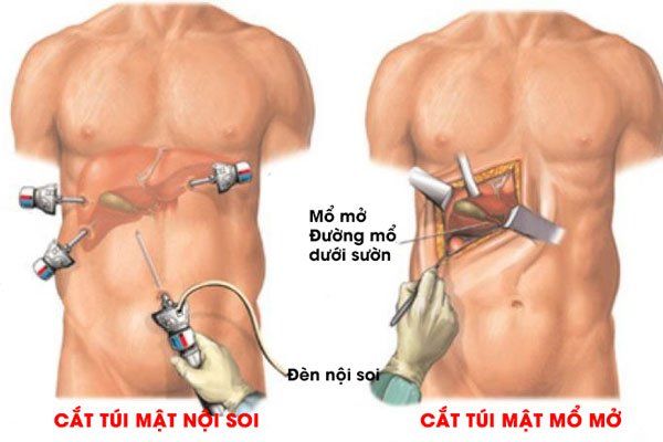 Ưu điểm của cắt túi mật nội soi