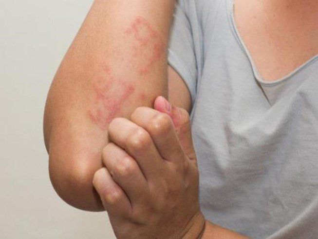 Thuốc Cotrimoxazole: Công dụng, chỉ định và lưu ý khi dùng