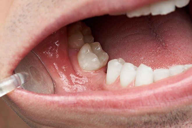 Vi khuẩn trong miệng sinh sôi, ảnh hưởng thế nào tới sức khỏe cơ thể bạn?