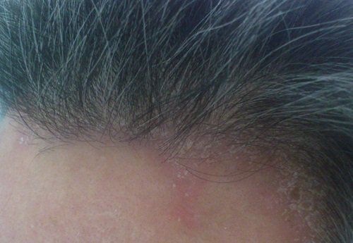 Hiểu về rụng tóc - Những điều cơ bản
