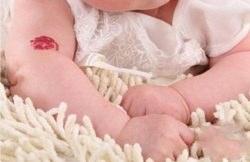 Tìm hiểu về các vết bớt ở trẻ sơ sinh thường gặp