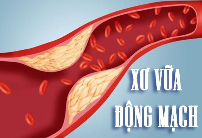 Xơ vữa động mạch não có thể gây tai biến mạch máu não