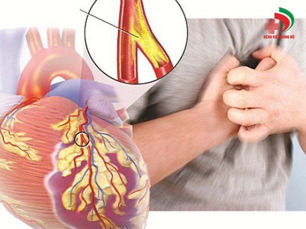 Siêu âm trong lòng mạch (IVUS) - Trợ thủ đắc lực giúp điều trị can thiệp bệnh động mạch vành